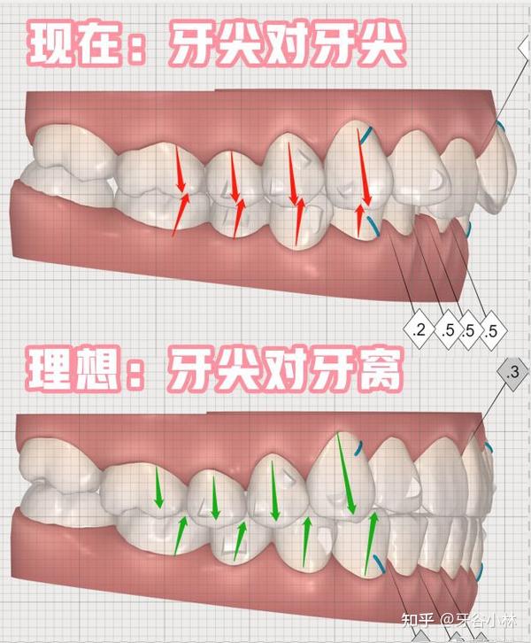 一般而言,正常的咬合关系是:上排牙齿的窝,对下排牙齿的尖,上排牙齿在