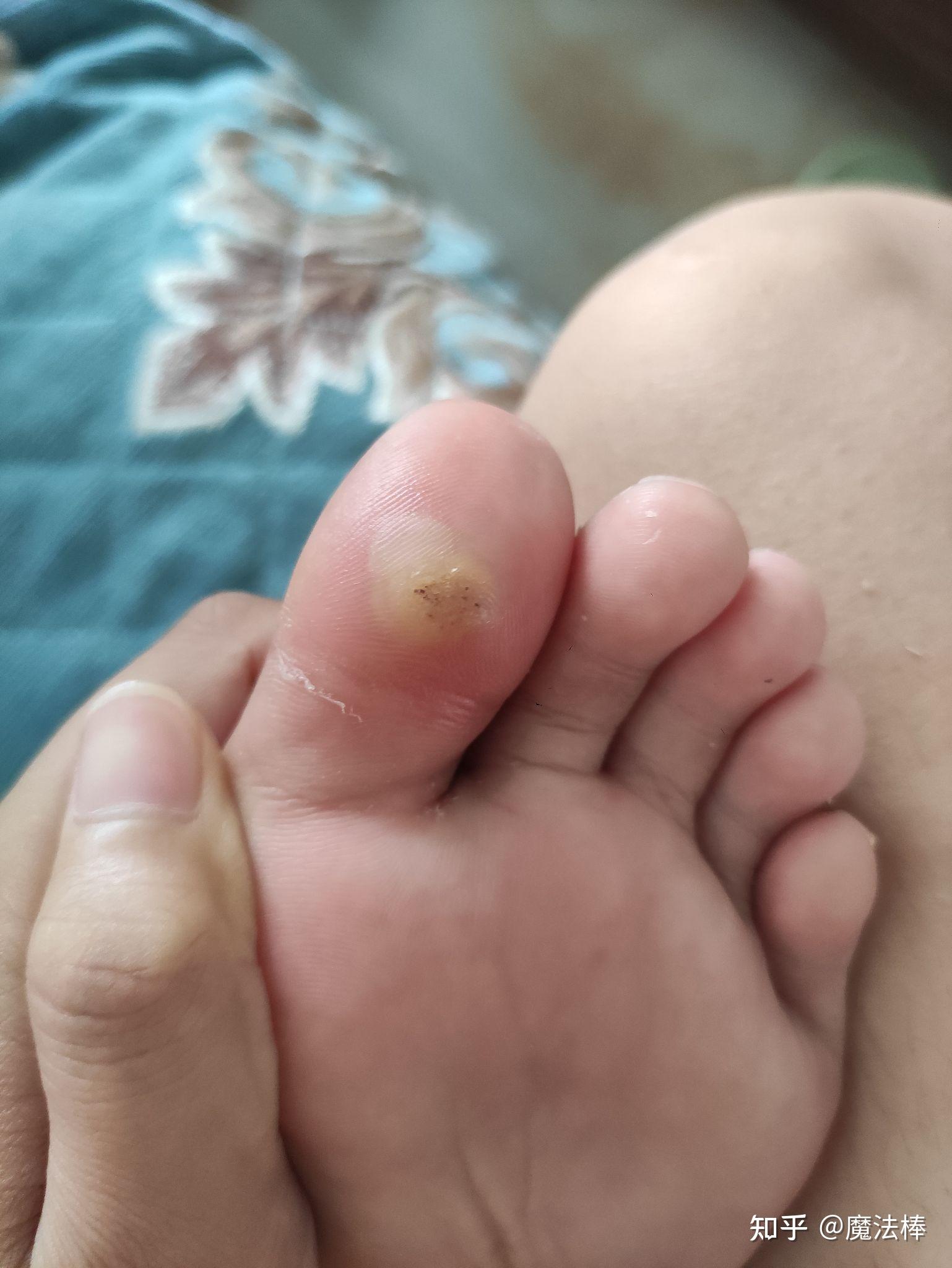 加油和跖疣做斗争