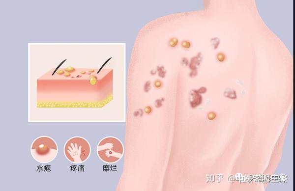 身上好多水泡是什么?怎么治疗?