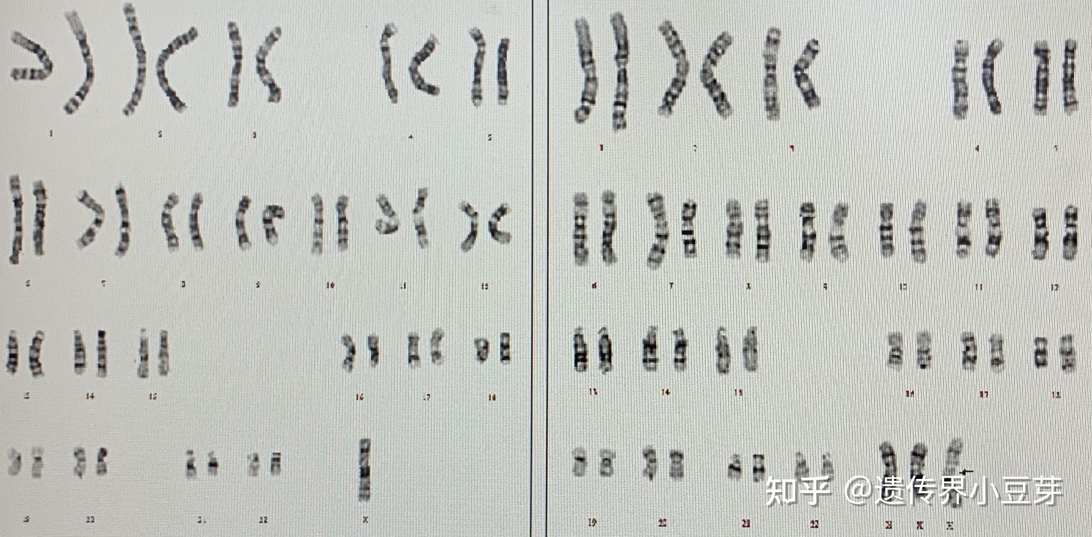 turner综合征有哪些遗传咨询要点