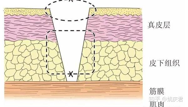 皮下减张缝合技术示意图