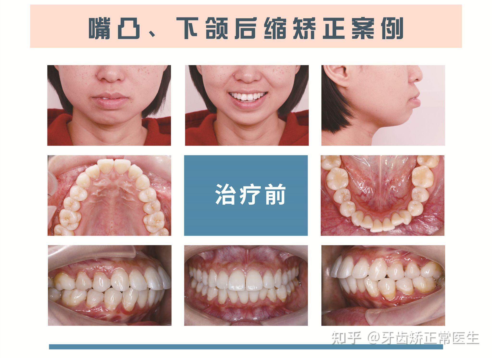郑州牙齿矫正常大桐成年女性嘴凸下颌后缩矫正案例