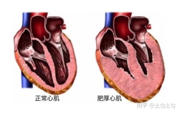 (如下图)简单来讲就是心肌肥大,导致血液循环异常,严重损害心脏功能及