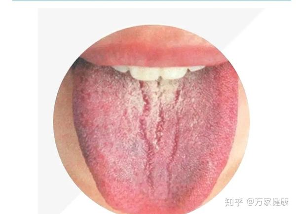 观察舌苔自己是否健康