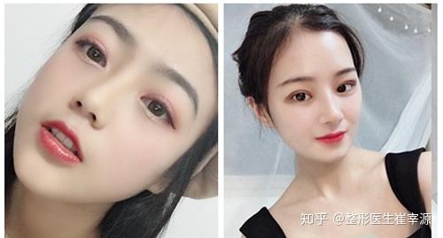 纯真医院崔宰源院长做双眼皮必须开眼角吗埋线双眼皮能维持几年时间才