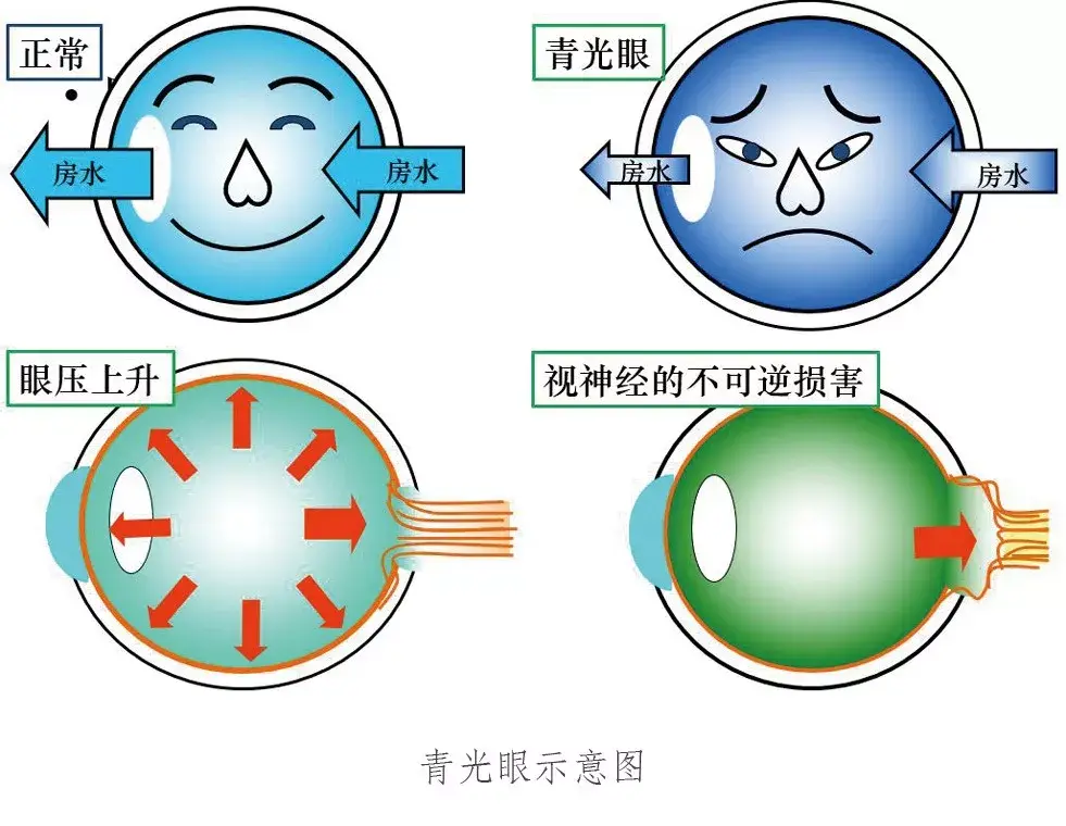 兽医学习分享丨犬原发性闭角型青光眼手术治疗青光眼引流阀植入术