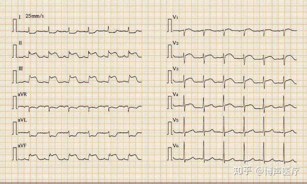 博声医疗:左室高电压,左室高电压心电图