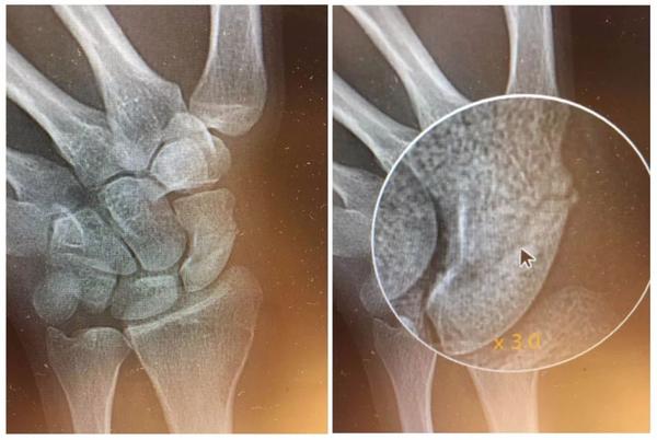 (scaphoid fracture/腕舟骨骨折)