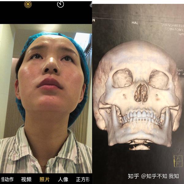 磨骨一年 ,真实感受分享.