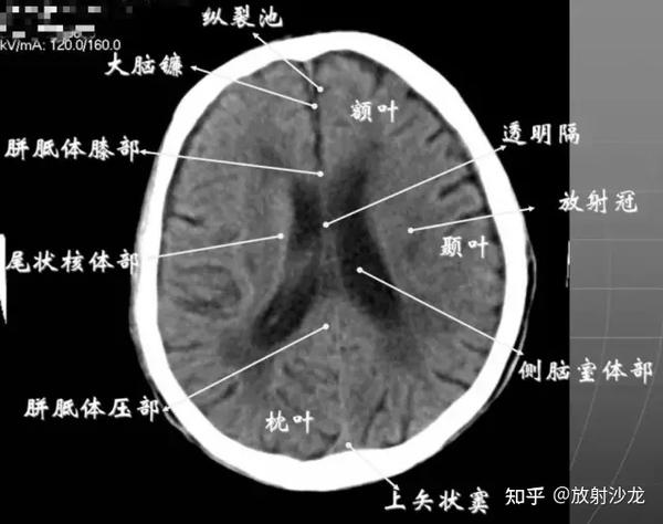 颅脑ct怎么看正常和异常影像分别是什么