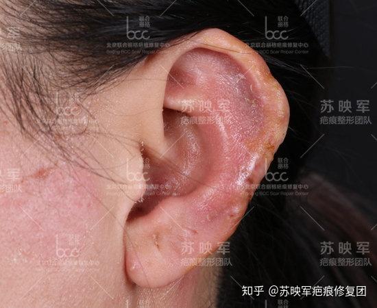 爱美女孩因"无痛穿耳"引发巨大疤痕疙瘩治疗后续
