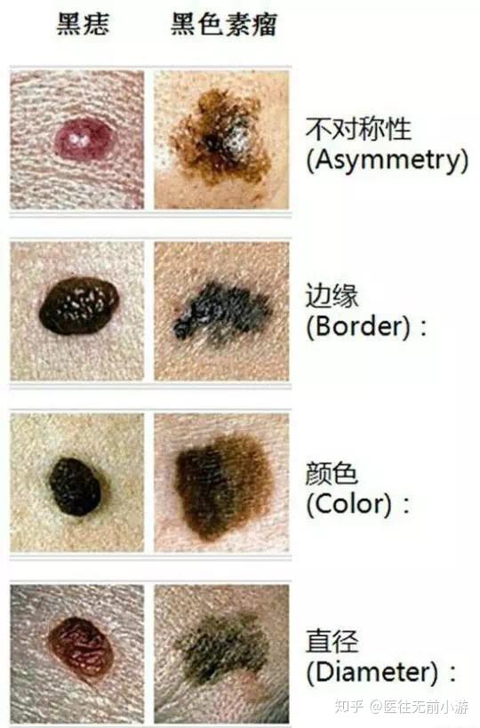 医生,我身上的痣真的会发生恶变吗?