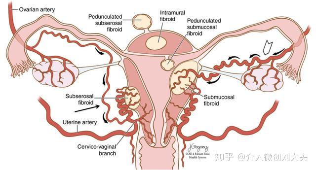 肌瘤造成宫腔解剖结构扭曲 影响子宫内膜,导致子宫容受性降低,影响