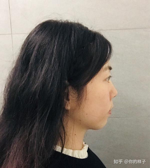 大龄女青年骨性嘴凸下巴后缩深覆合
