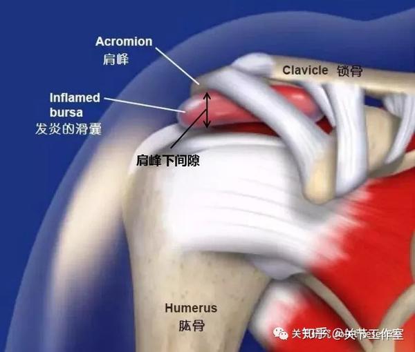 撞击的关节3肩峰下撞击综合征