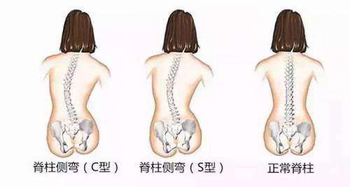 脊柱侧弯常见问题解答(上)——脊柱外科专家吴星火科普系列