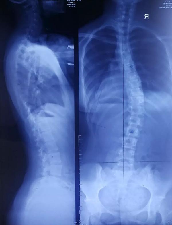 脊柱侧弯如何正确拍摄x光片