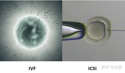 浆内单精子注射(icsi,也就是我们常说的一代试管婴儿和二代试管婴儿