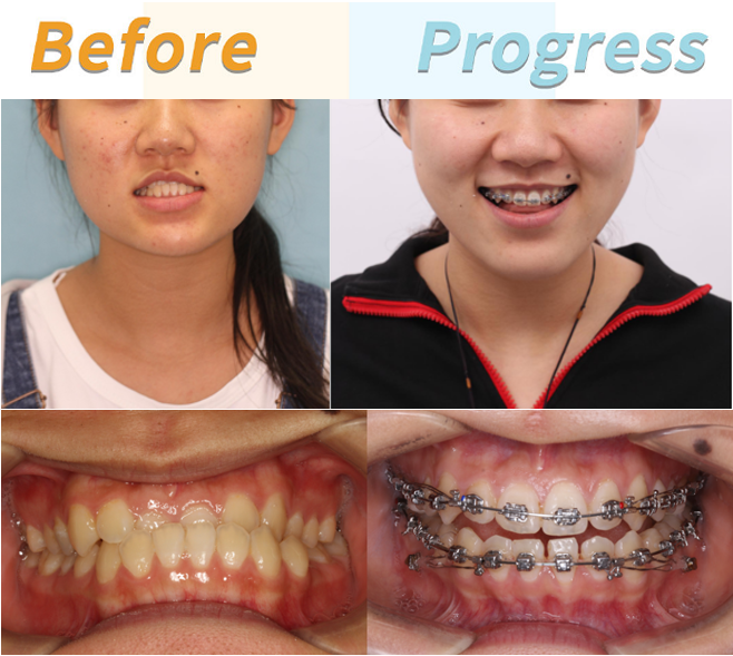 郑州牙齿矫正:成人地包天(反颌又称兜齿)矫正病例