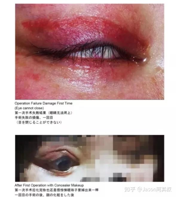 第一次手术后化完妆也还是很惊悚眼珠子要掉出来一样