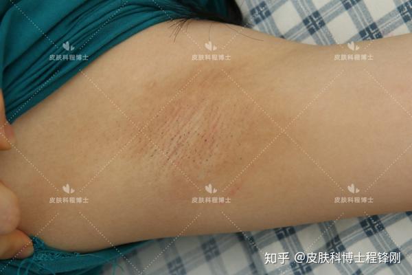 22岁女生,双侧腋下狐臭严重 案例10