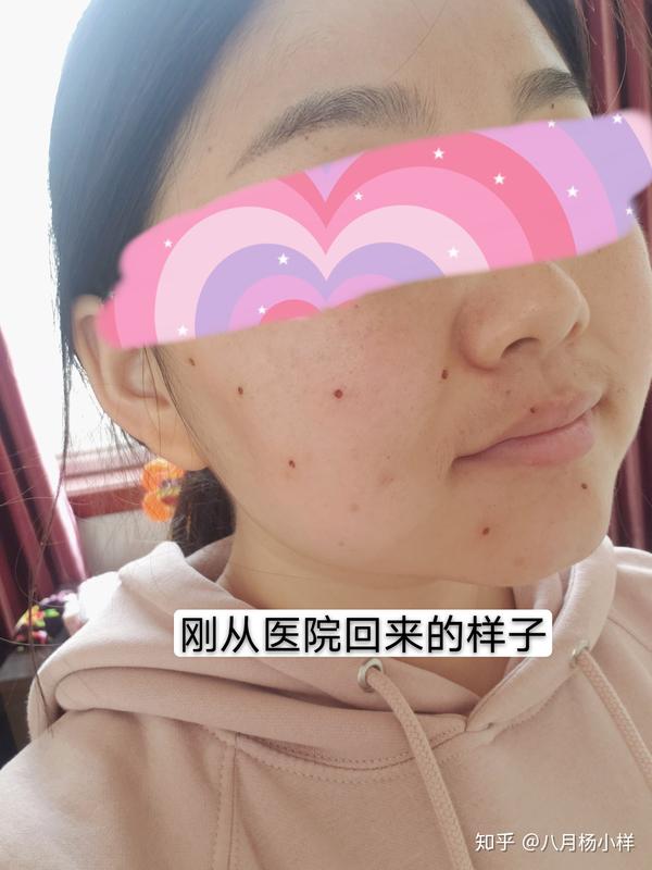 疫情期间我纹眉完又去祛痣啦