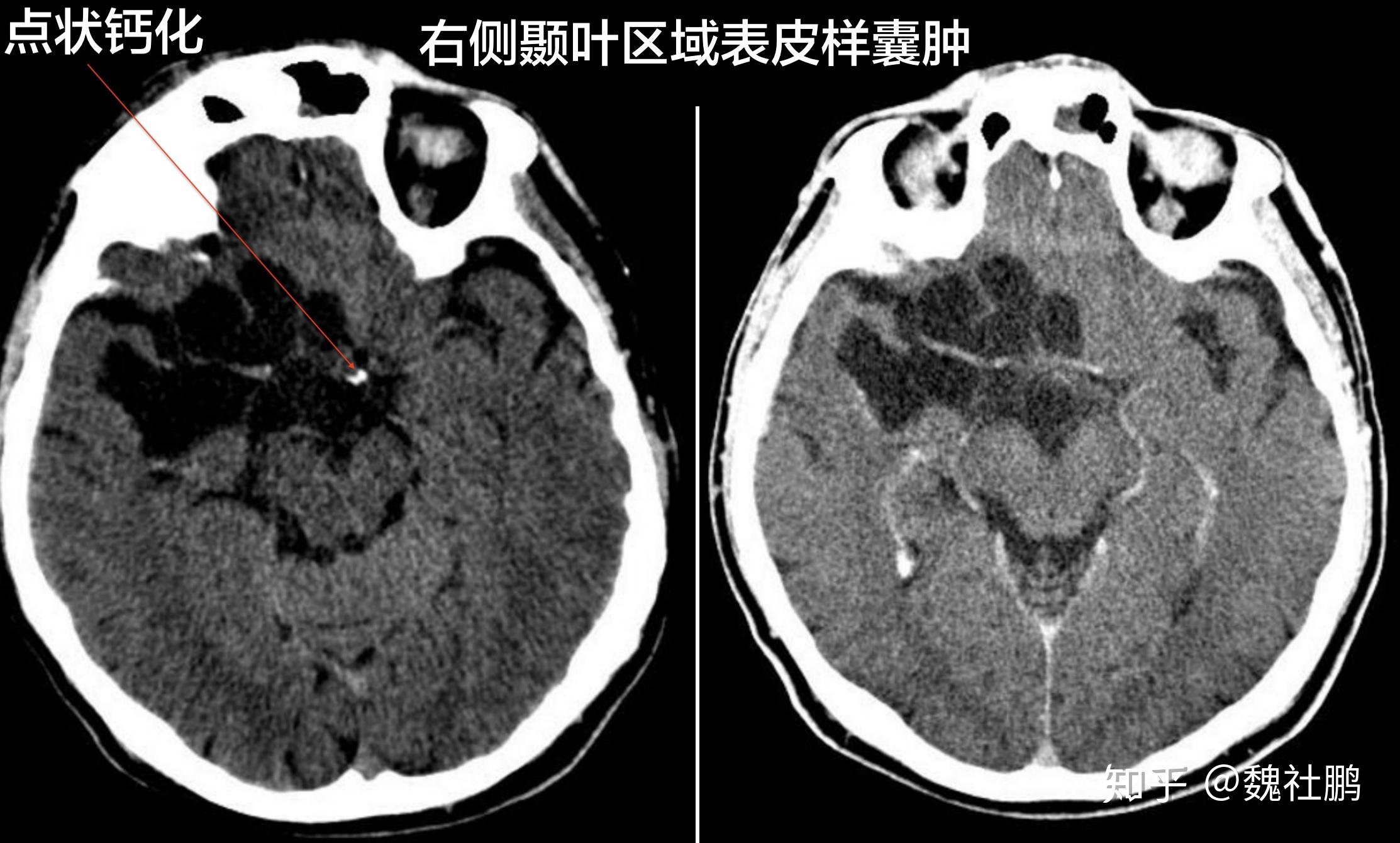 颅内表皮样囊肿和皮样囊肿