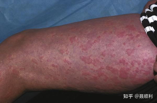 表现为:与荨麻疹相似的游走性红斑样皮疹,发热,生长障碍,慢性无菌性脑