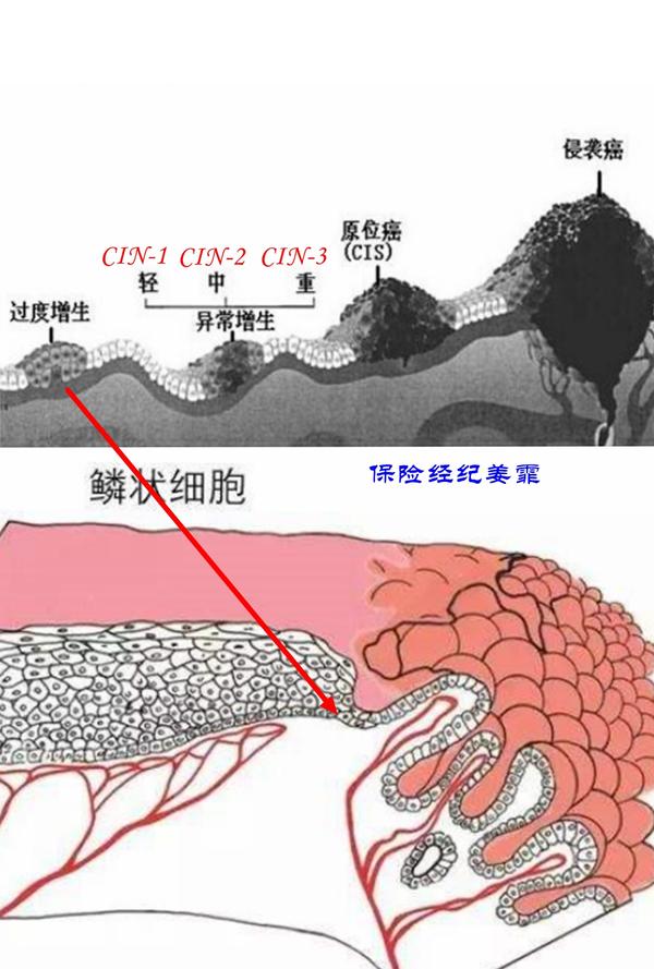 解析女性易患的重大疾病宫颈癌