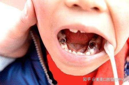 杭州美奥口腔:宝宝几岁开始换牙?多久换完?父母稍不注意孩子一口坏牙!