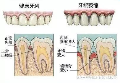 从剖面图看,明显的牙龈和牙周组织的萎缩,骨头的吸收也非常明显.