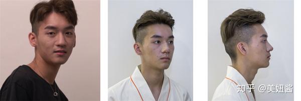 术前大鼻头,鼻翼外扩,鼻基底凹陷
