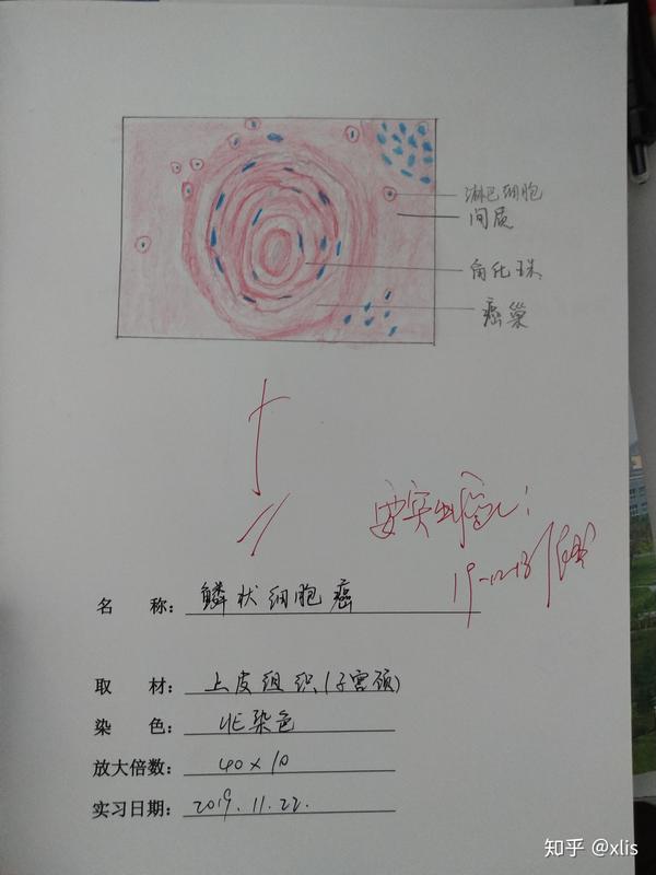 鳞状细胞癌 红蓝铅笔手绘