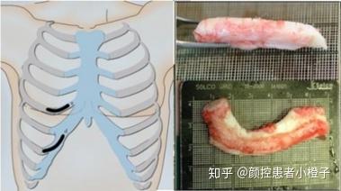 取肋软骨隆鼻对人体伤害有多大