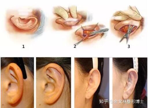 余文林解读:招风耳需不需要手术矫正?