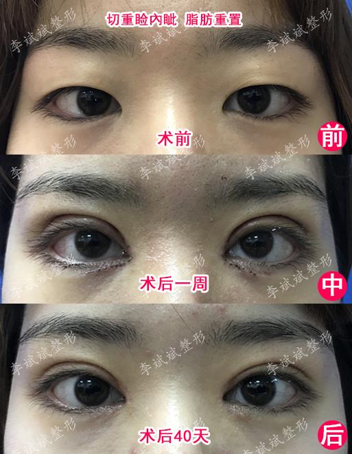 下一讲咱们来聊一聊双眼皮如何护理才能有效抑制瘢痕增生,防止并发症