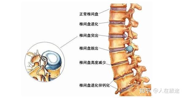 我们常说的腰间盘突出,也就是医学上的椎间盘突出,多发生在腰4腰5