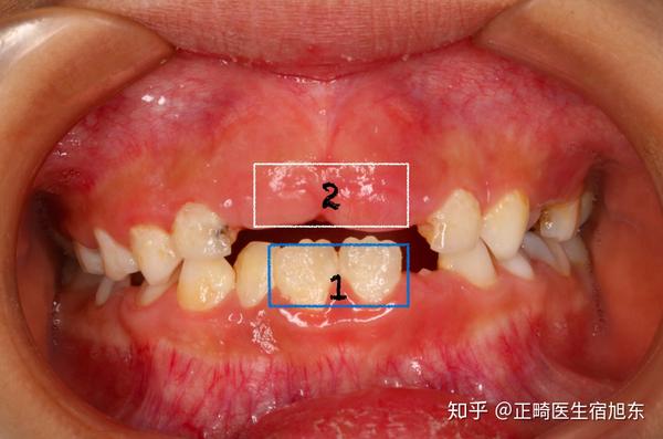换牙阶段首先是下面门牙乳牙替换后,上门牙才开始长出来.