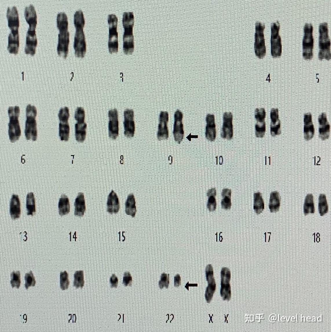 其 中绝大多数为9号和22号染色体之间的平衡易位,即t(9 22(q34;q11)