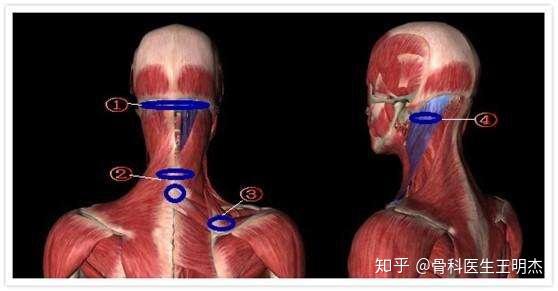 颈肩腰腿痛与肌肉骨骼平衡失调的相关性
