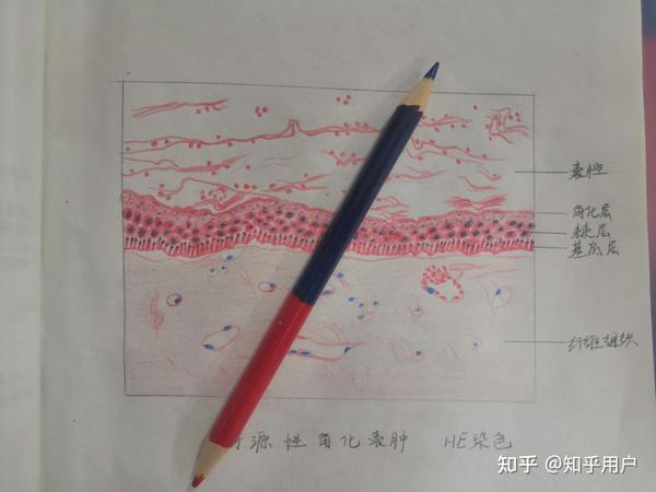 成釉细胞瘤和牙源性角化囊肿红蓝铅笔