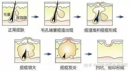 重庆白癜风医院:痘印还难受的痘坑,用这些方法可以消除!