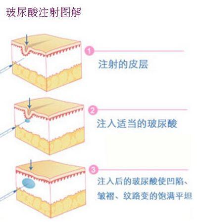 传说中的玻尿酸,到底是什么?