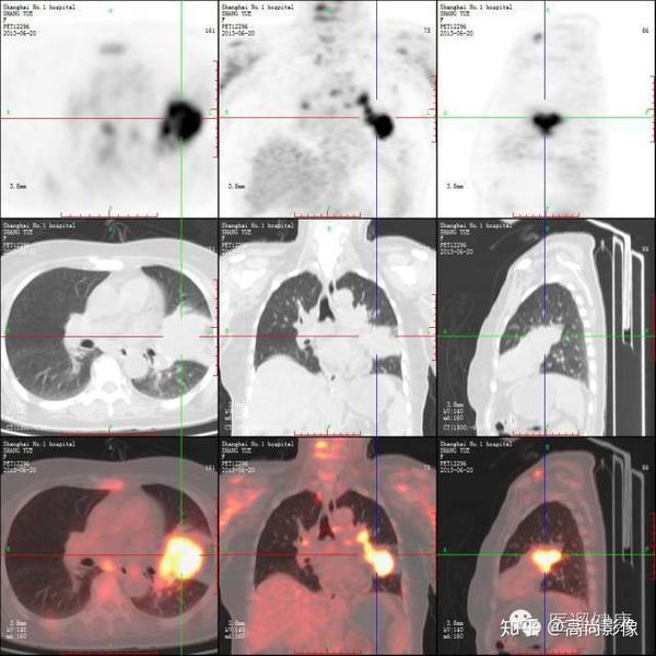 西安高尚医学影像:pet/ct在肿瘤治疗决策中的应用