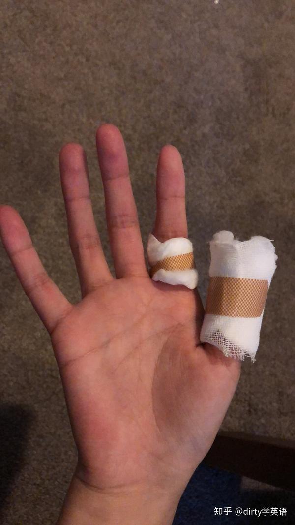 手指被车门夹伤以后.