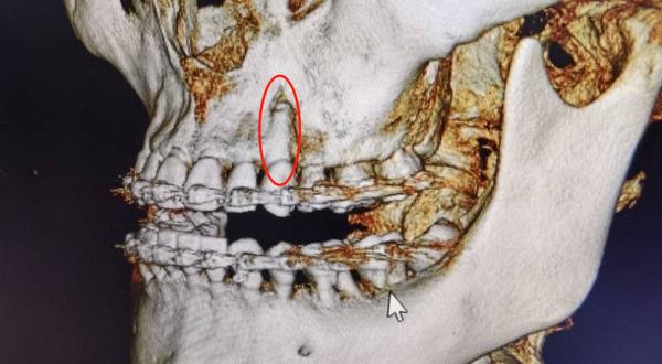 牙齿矫正会导致骨开窗骨开裂这种情况该如何判断