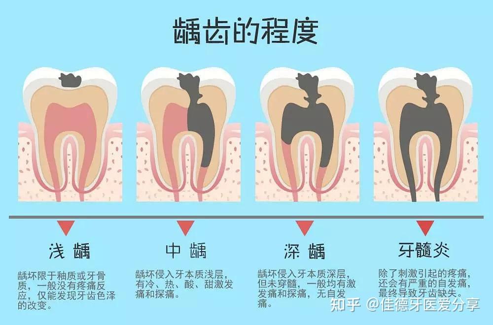 呵护儿牙儿童龋齿预防!