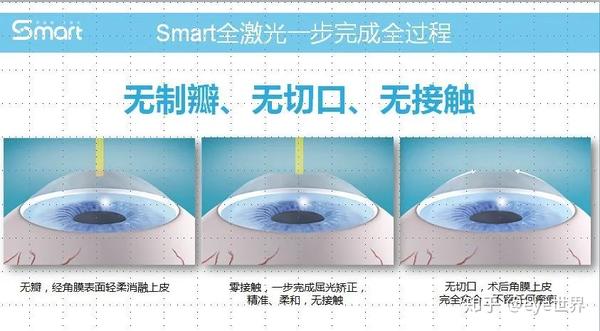 近视手术【术式区别】:icl/smart/全飞秒/半飞秒
