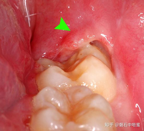 一颗智齿从牙龈向外突出,背部发炎(心包炎;绿色箭头)