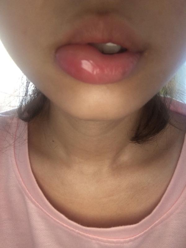 嘴唇上被咬到蚊子包是一种怎样的体验?